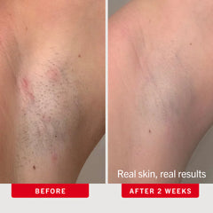 Ingrown Hair Pads with BHA + AHA Travel Size