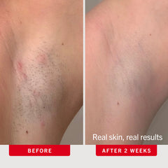 Ingrown Hair Pads with BHA + AHA